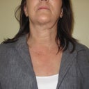 neck and scar under chin