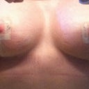 AFTER- 3 WEEKS POST OP, ANOTHER VIEW FROM FRONT. Again, you can see some indentations from the bra in some spots, which may look like stretch marks, but they are from swelling. Please stay perky, Girls!!!