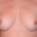 Pre-op pic for reference, old ones got deleted. Size 32 B on left/32 C right.