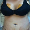 Starting day 3 ... 48 hours after surgery