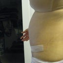 here you can see the bulge above belly button