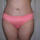 8 months post op