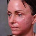 20 days after procedure, scarring resulted.
