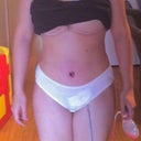 1 week post op