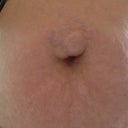 Damn hernia up close