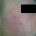 Right Cheek