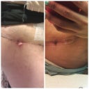 this was the before and after of my wound (as of yesterday)