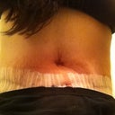 1 wk PO - swelling