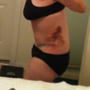 1 wk PO - swelling - scar is low, I just have my grannies pulled down.