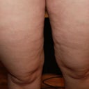 Before Inner/front thighs - taken the night before surgery