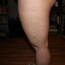 Before outter left thigh - taken the night before surgery
