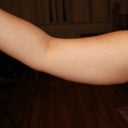 Before right arm - taken the night before surgery