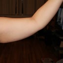 Before left arm - taken the night before surgery
