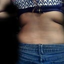 back pre op