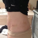 Three weeks post surgery