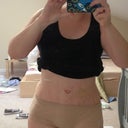 Three weeks post surgery