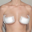 3 Days Post-Op Front