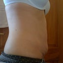 6 months post op: pouchy tummy