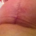 incision close up week 3..that extra horizontal line is an ident from my sports bra so ignore