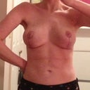 end of week 3, better lighting so you can really see the incisions here, still very red and raised but no issues with opening or anything like that...my surgeon used sitches that disolved on their own