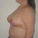 Ten days post op