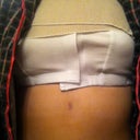 post op day of surgery