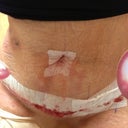 1st post-op visit.