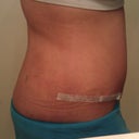 Week 1 post op