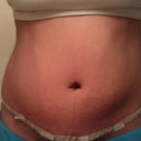 week 1 post op
