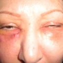 About a month after injections under eyes
