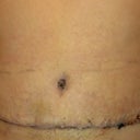 3 weeks post op...drying up nicely... About to start the scar therapy...