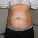 Pre-surgery