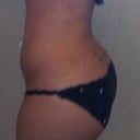 5 weeks Post Op :D