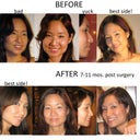 pre and post-surgery rhinoplasty pics