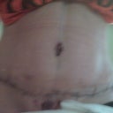 4 days post op
