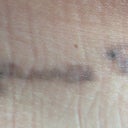 5 weeks and 3 days after 2nd treatment
