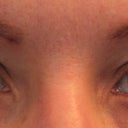 both eyes, before (April 2010)