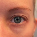 left eye, before