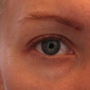 right eye, before