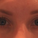 both eyes after (I do have a tiny bit of mascara, for color purposes) July 2010