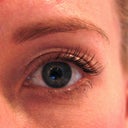 left eye, after