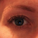 right eye, after