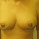 Day 4 with steri-strips