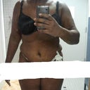 Really Swollen,,2 weeks post Op
