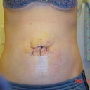 4 days post-op