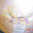 6 days post-op