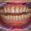 Implant-Supported Lower Denture