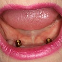 Implant-Supported Lower Denture