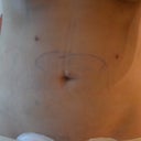 24 hours Post Op