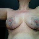 Two weeks post op